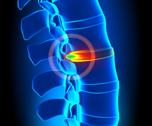 Stem Cell Therapy for Spinal Pain and Injuries